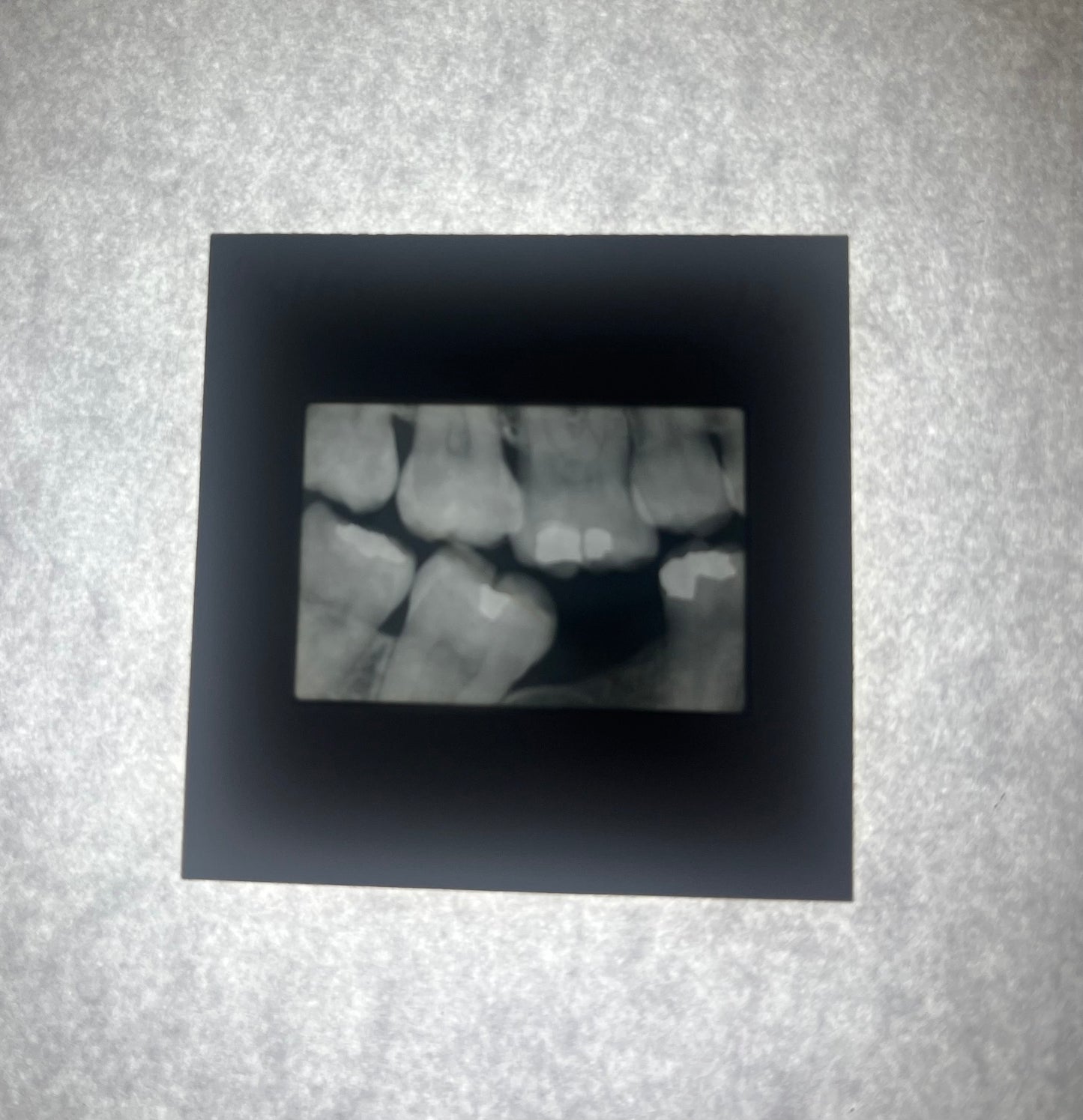 Dental X-Ray (Bitewing) Slide