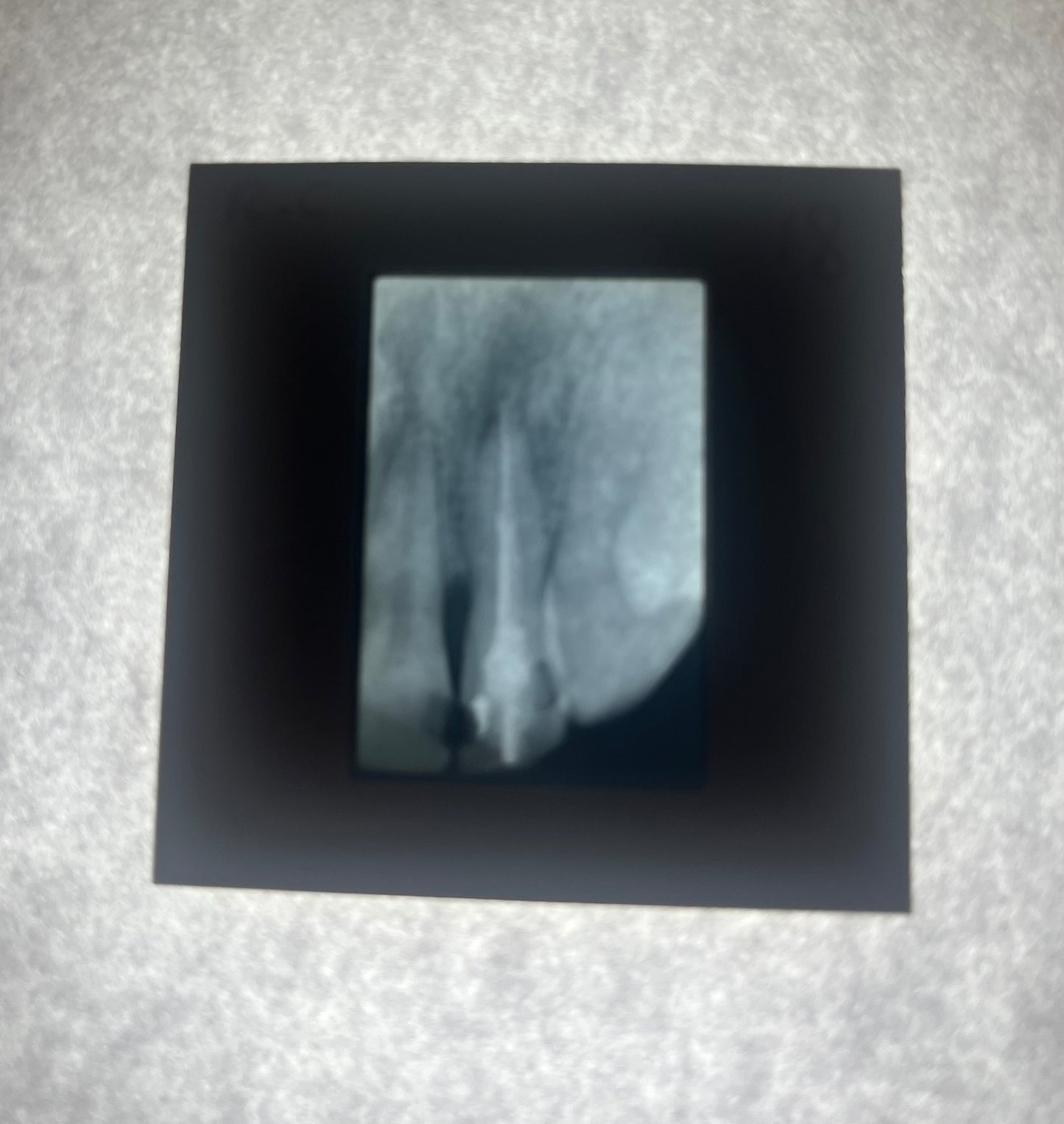 Dental X-Ray (Bitewing) Slide