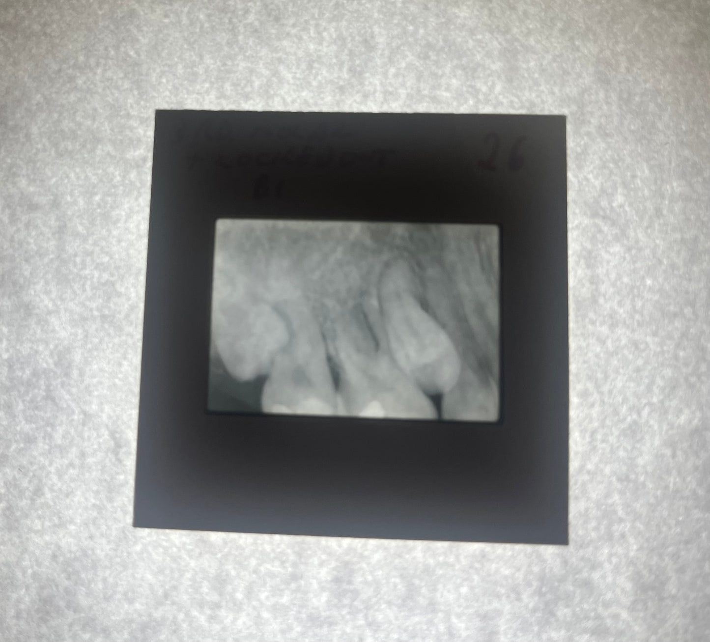 Dental X-Ray (Bitewing) Slide