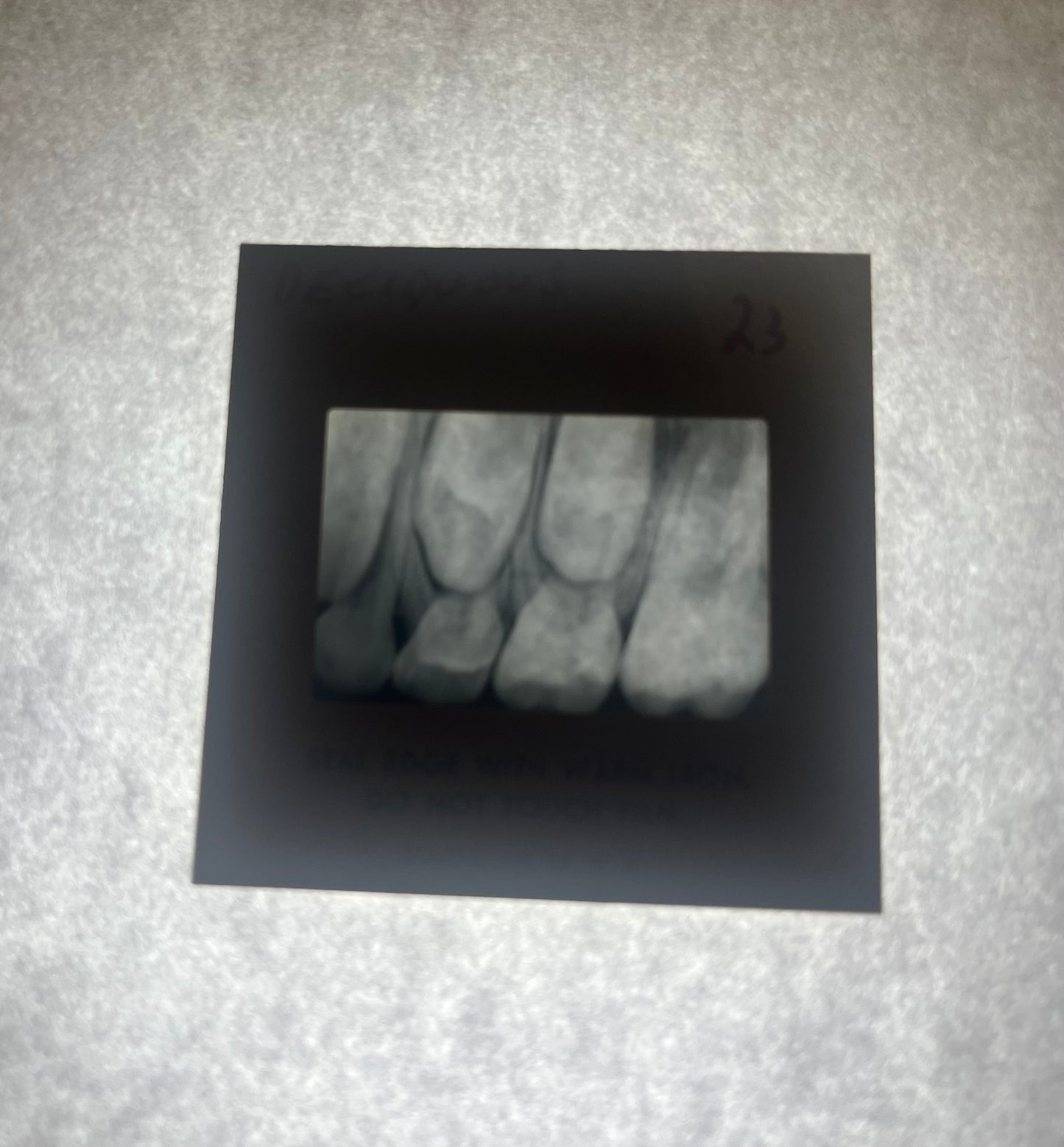 Dental X-Ray (Bitewing) Slide