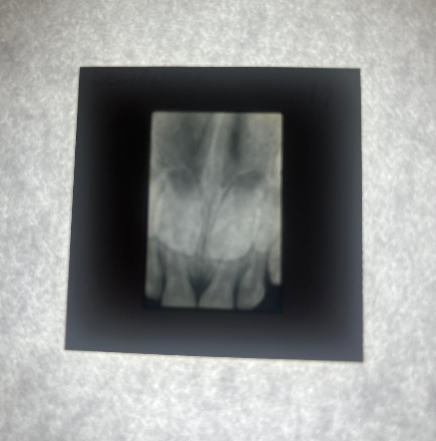 Dental X-Ray (Bitewing) Slide