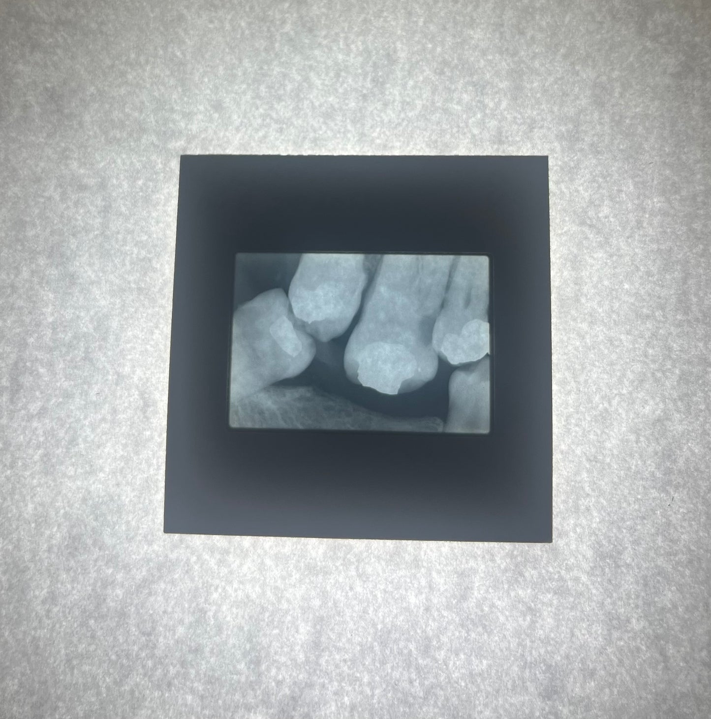 Dental X-Ray (Bitewing) Slide