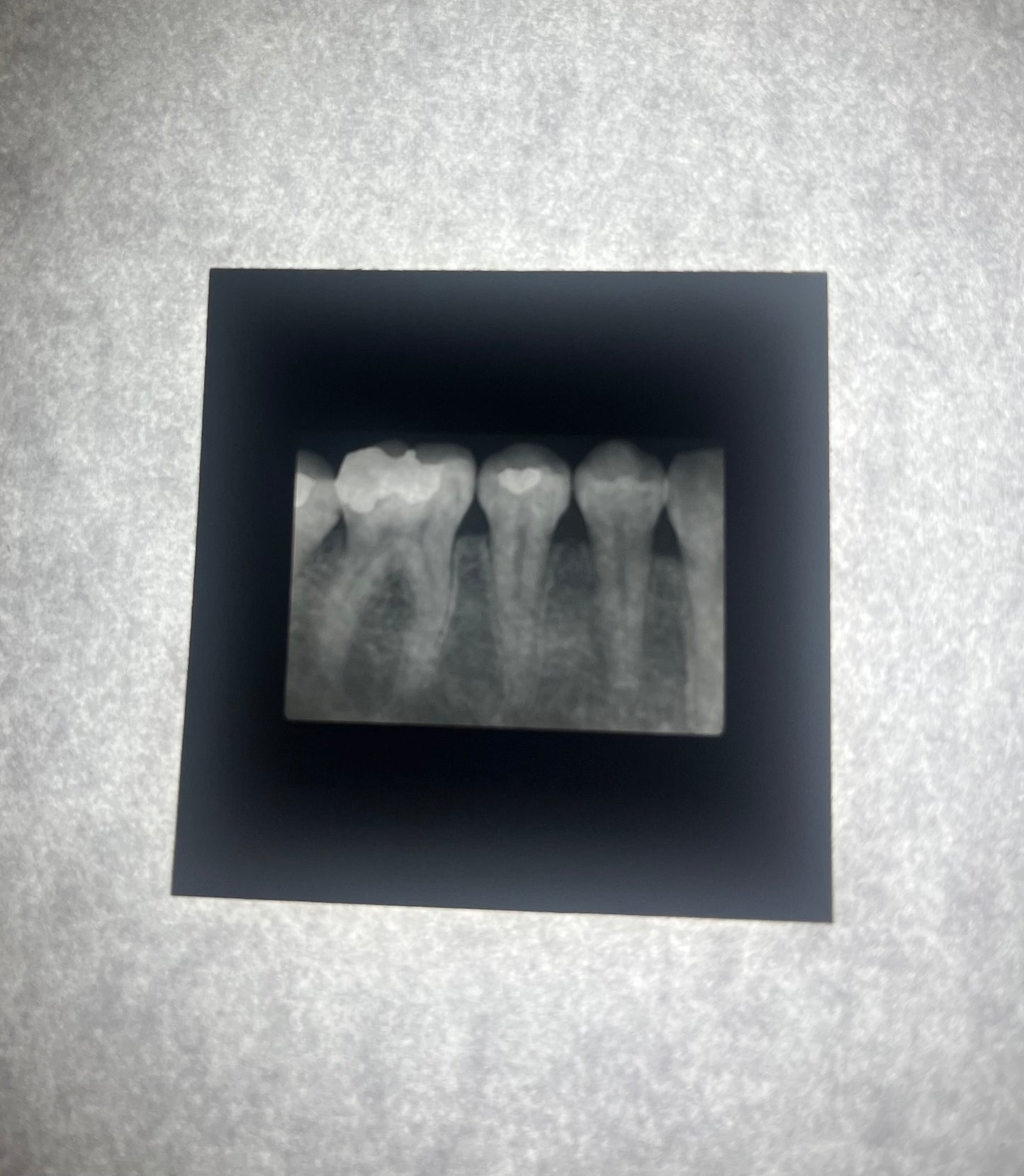 Dental X-Ray (Bitewing) Slide