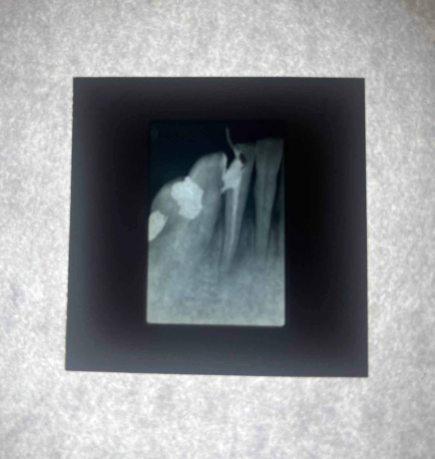 Dental X-Ray (Bitewing) Slide