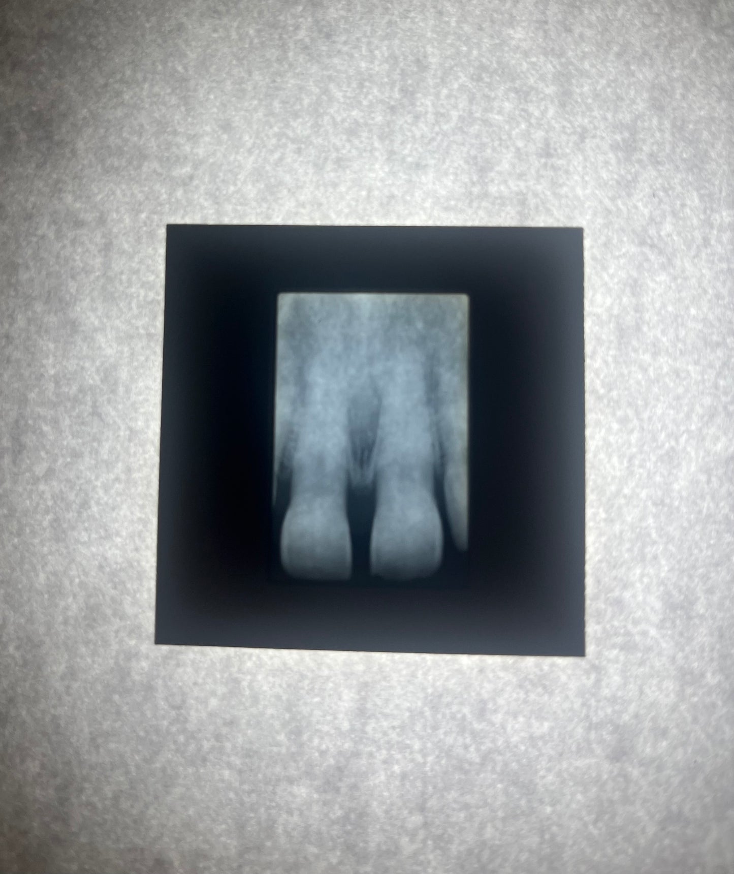 Dental X-Ray (Bitewing) Slide
