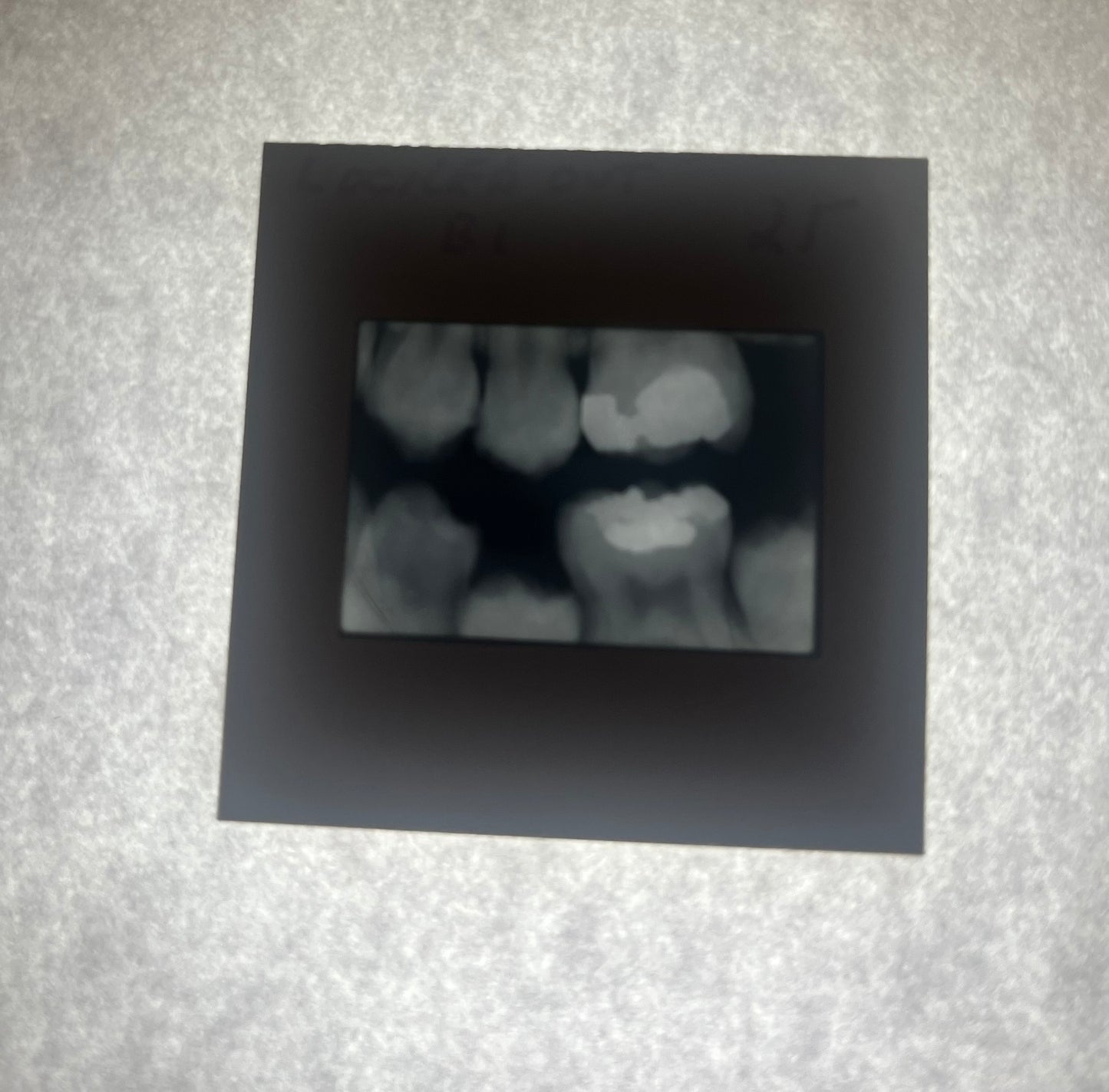 Dental X-Ray (Bitewing) Slide