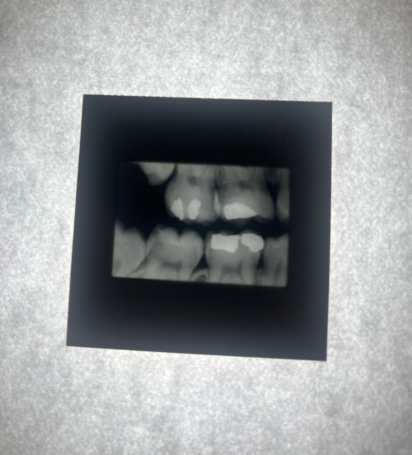 Dental X-Ray (Bitewing) Slide