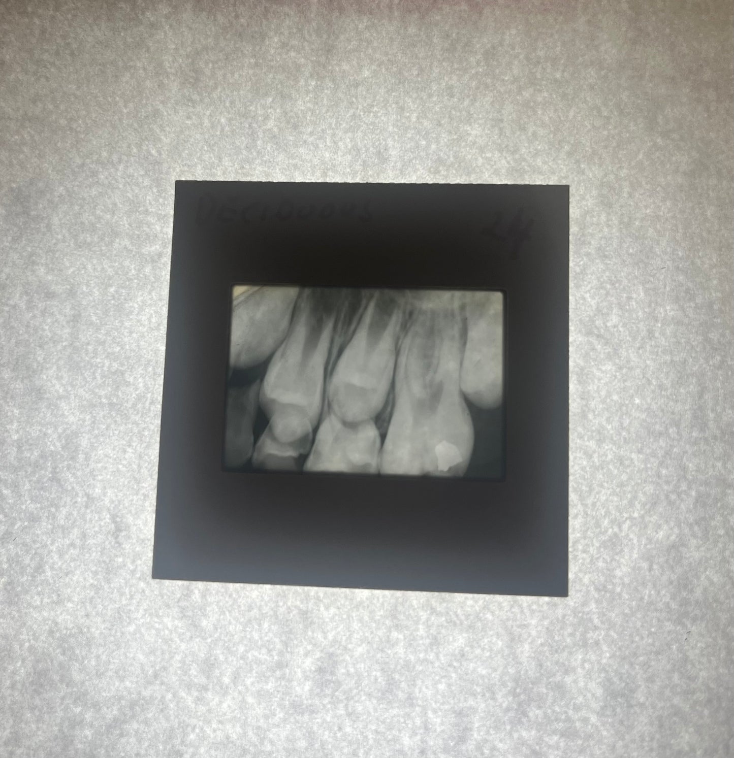 Dental X-Ray (Bitewing) Slide