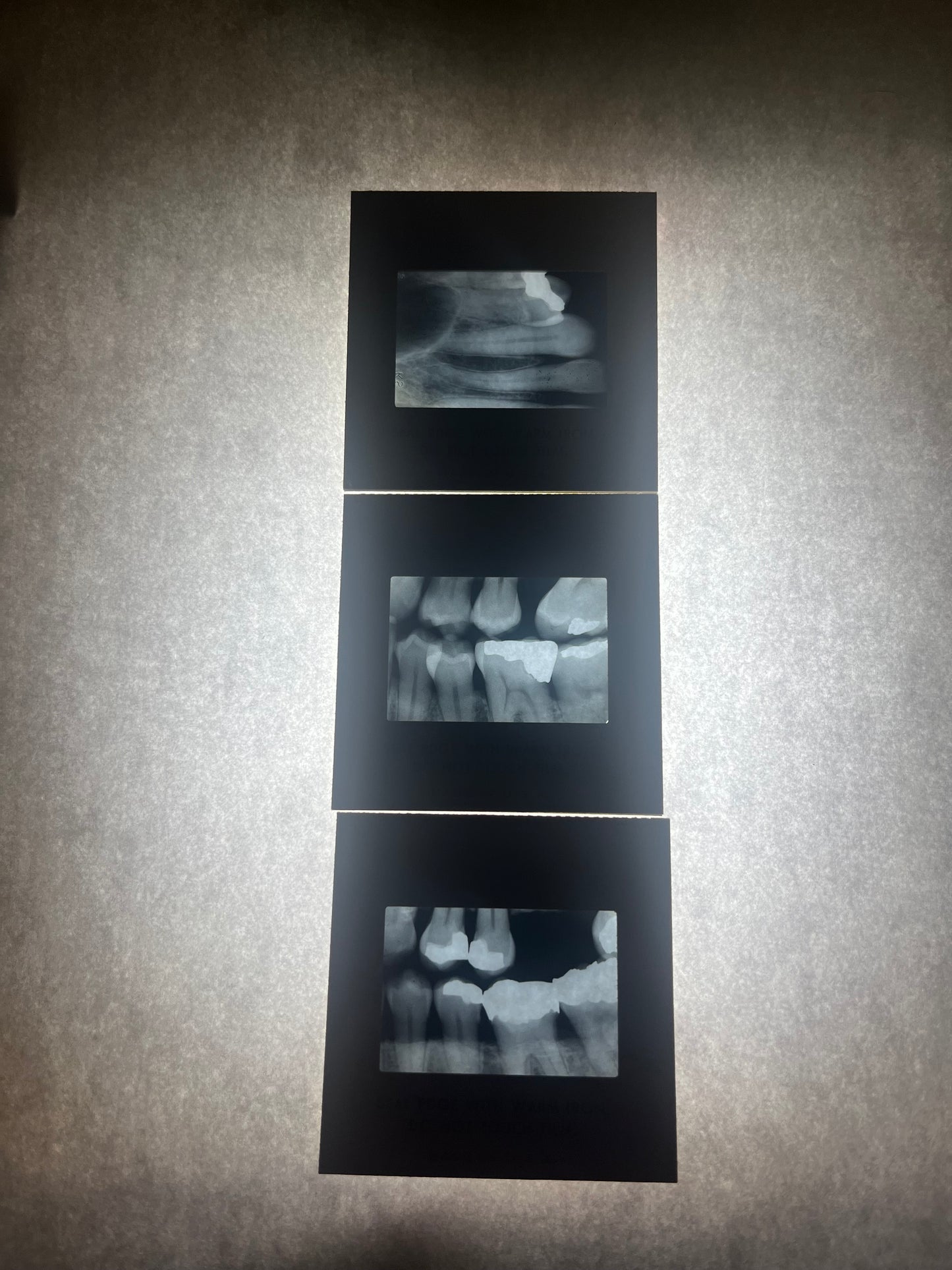 Dental X-Ray (Bitewing) Slide