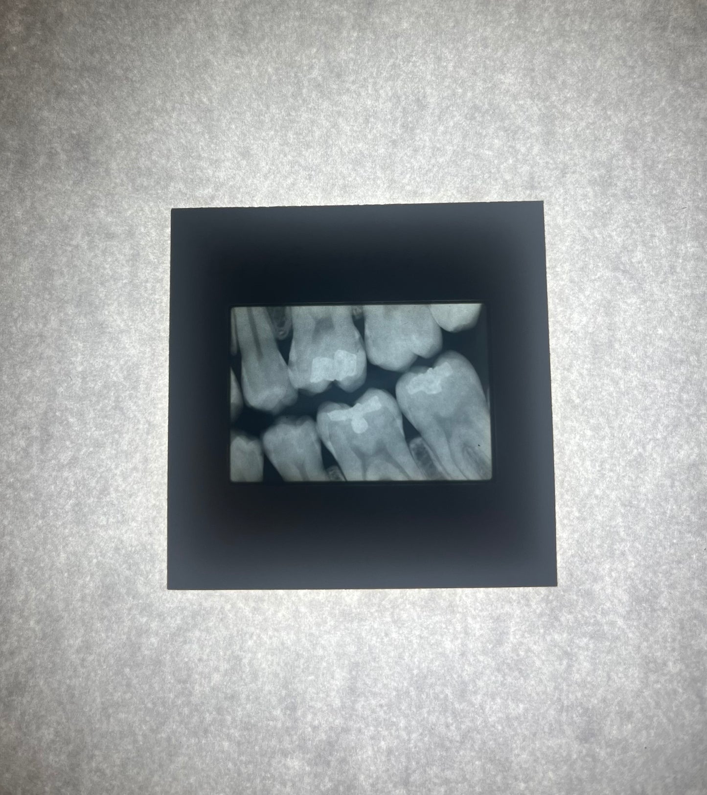 Dental X-Ray (Bitewing) Slide