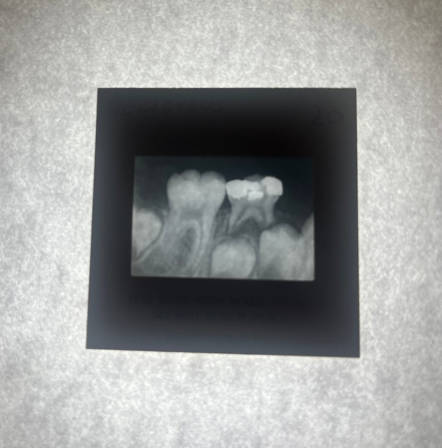 Dental X-Ray (Bitewing) Slide