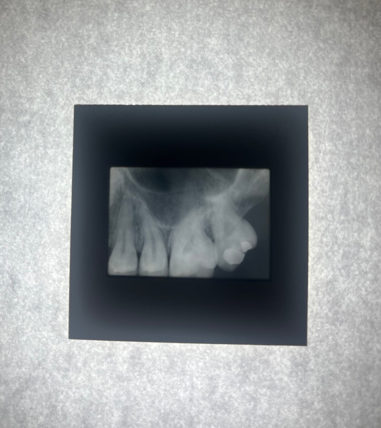 Dental X-Ray (Bitewing) Slide