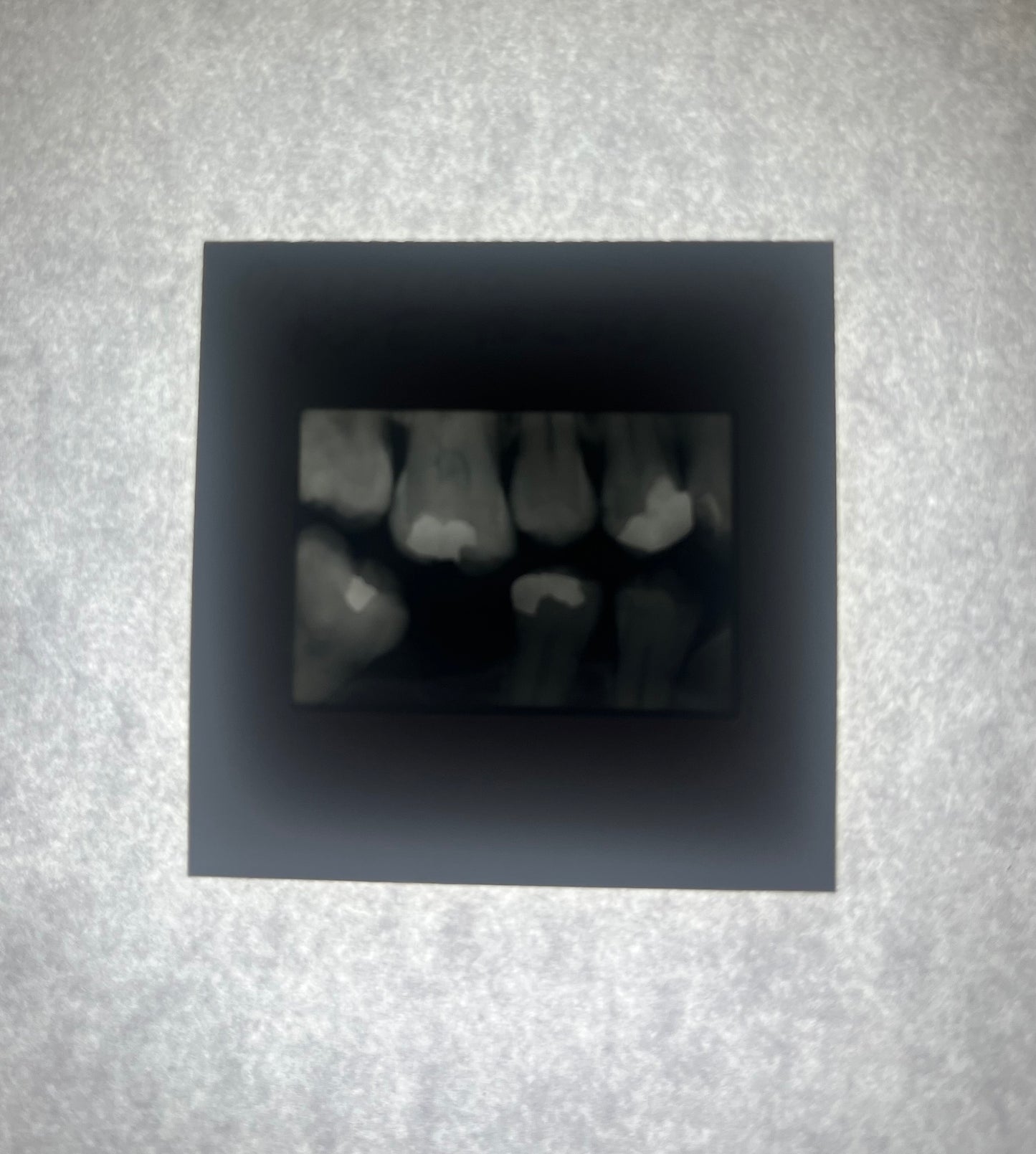 Dental X-Ray (Bitewing) Slide
