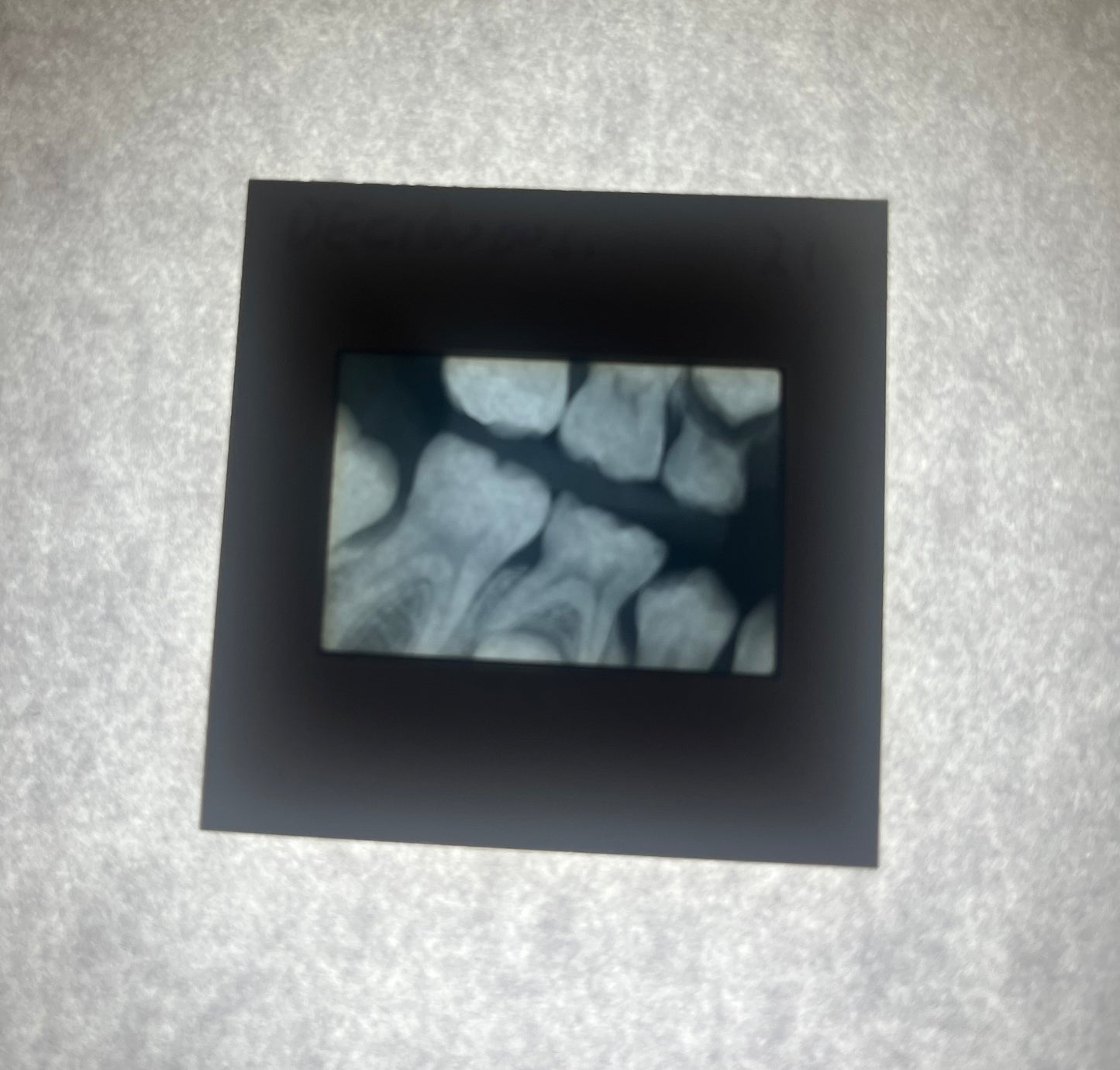 Dental X-Ray (Bitewing) Slide