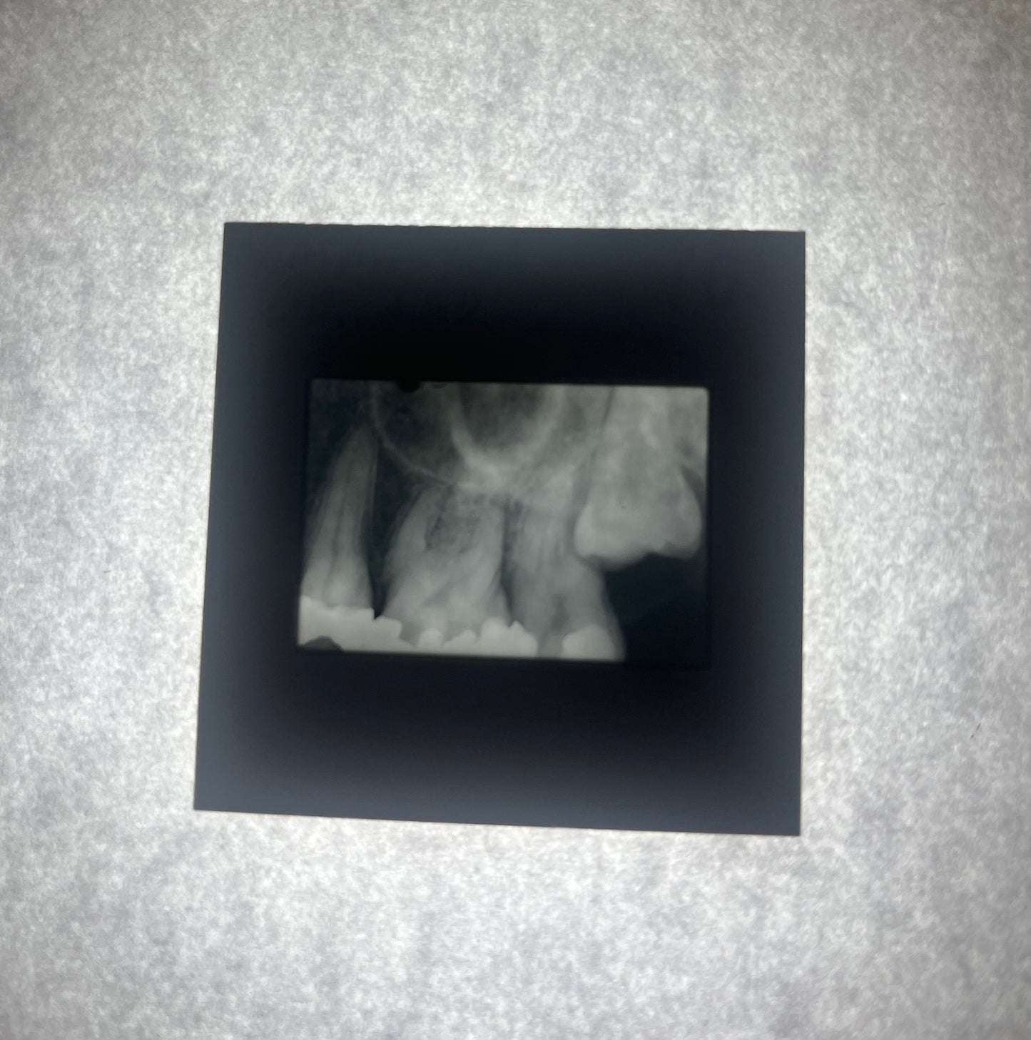 Dental X-Ray (Bitewing) Slide