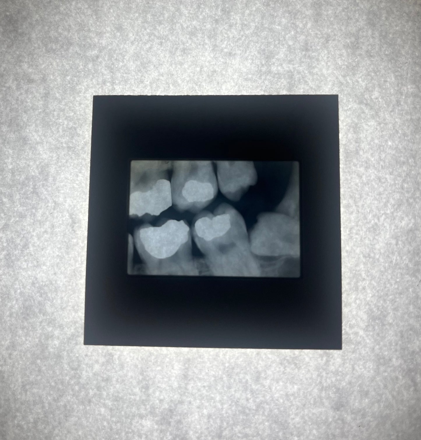 Dental X-Ray (Bitewing) Slide