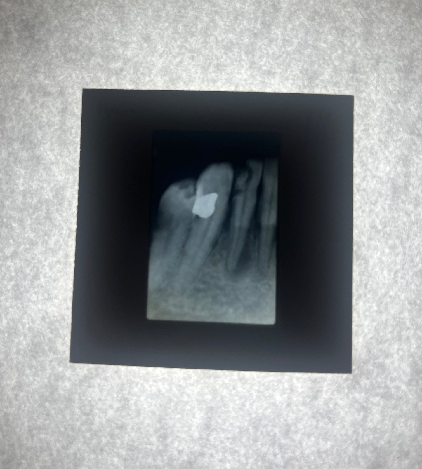 Dental X-Ray (Bitewing) Slide