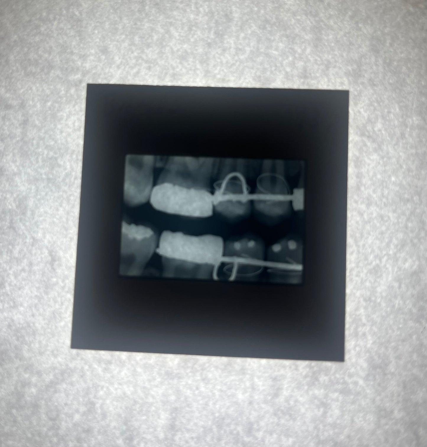 Dental X-Ray (Bitewing) Slide