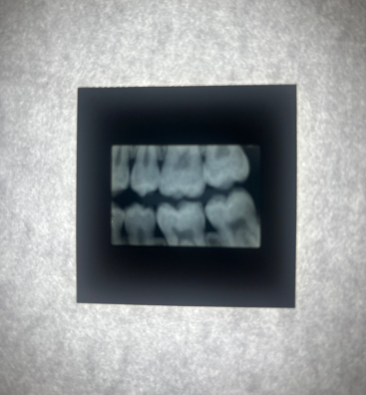 Dental X-Ray (Bitewing) Slide