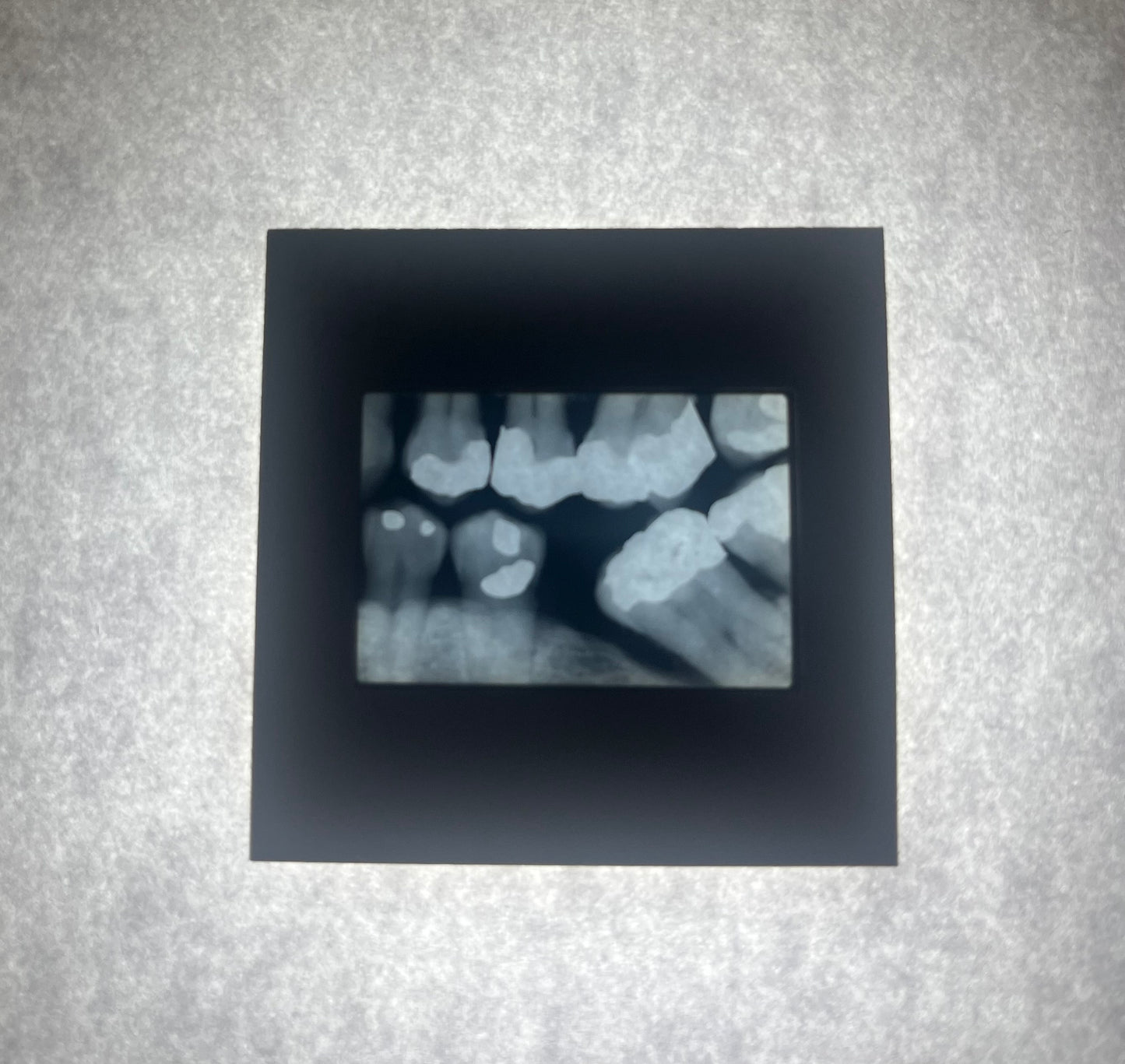 Dental X-Ray (Bitewing) Slide