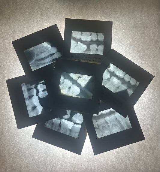 Dental X-Ray (Bitewing) Slide