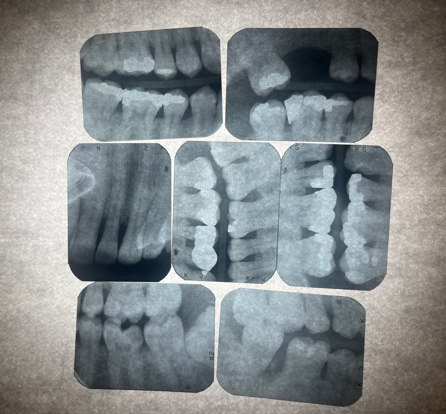 Dental X-Ray (Bitewing)