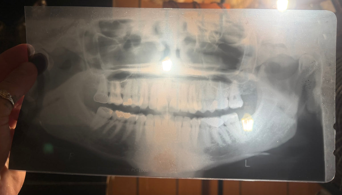 Dental X-Ray (Panoramic)