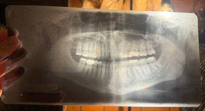 Dental X-Ray (Panoramic)